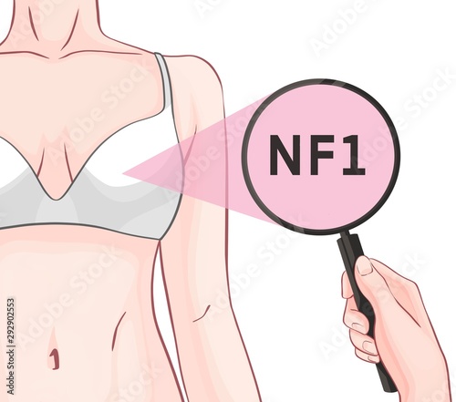 Variants in the NF1 gene are associated with an increased risk of developing breast cancer