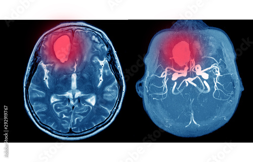 MRA AND MRV OF BRAIN Multiple acute intracranial hemorrhage at bilateral frontal lobes.