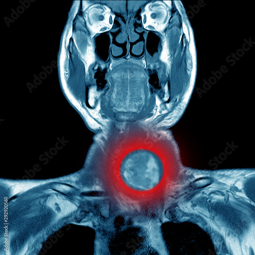 Magnetic resonance imaging (MRI) of neck,case of neck IMPRESSION:-Deep neck infection in retropharyngeal space cyst at lower pole of Lt lobe of thyroid photo