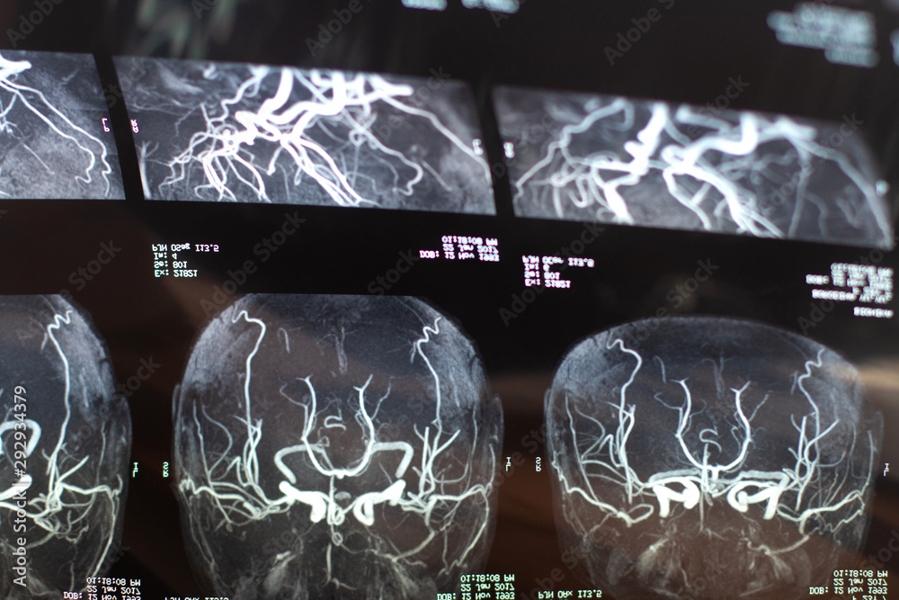 magnetic resonance image MRI picture of brain Stock Photo | Adobe Stock