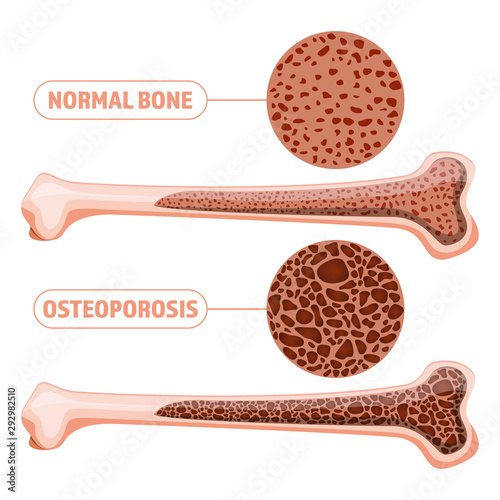 Osteoporosis vector design illustration isolated on white background photo