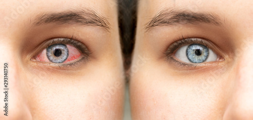 A before and after view of a beautiful caucasian girl who was suffering from red eye (conjunctivitis), results of successful antibiotic eye drops treatment.