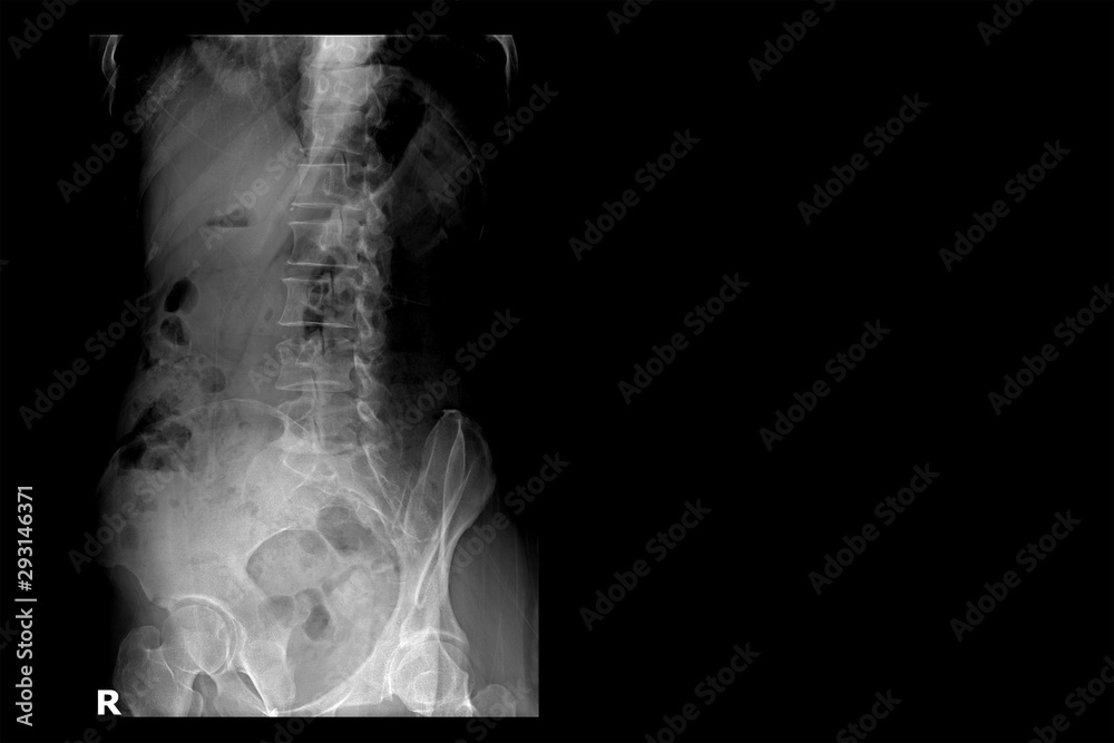 Xray image of lumbar spine (right side).Lumbar Degenerative Spinal Canal Stenosis or Herniated