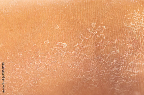 A closeup and macro view in the dry, flaky skin of a caucasian person, filling the frame with detail, dried out in need of dermatologist and moisturization.
