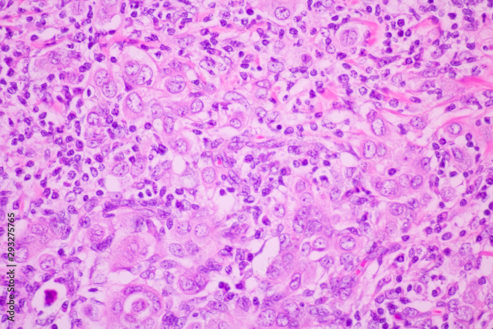 Section tissue of breast cancer view in microscopy.Ductal cell carcinoma. Section tissue of breast cancer view in microscopy.Ductal cell carcinoma.