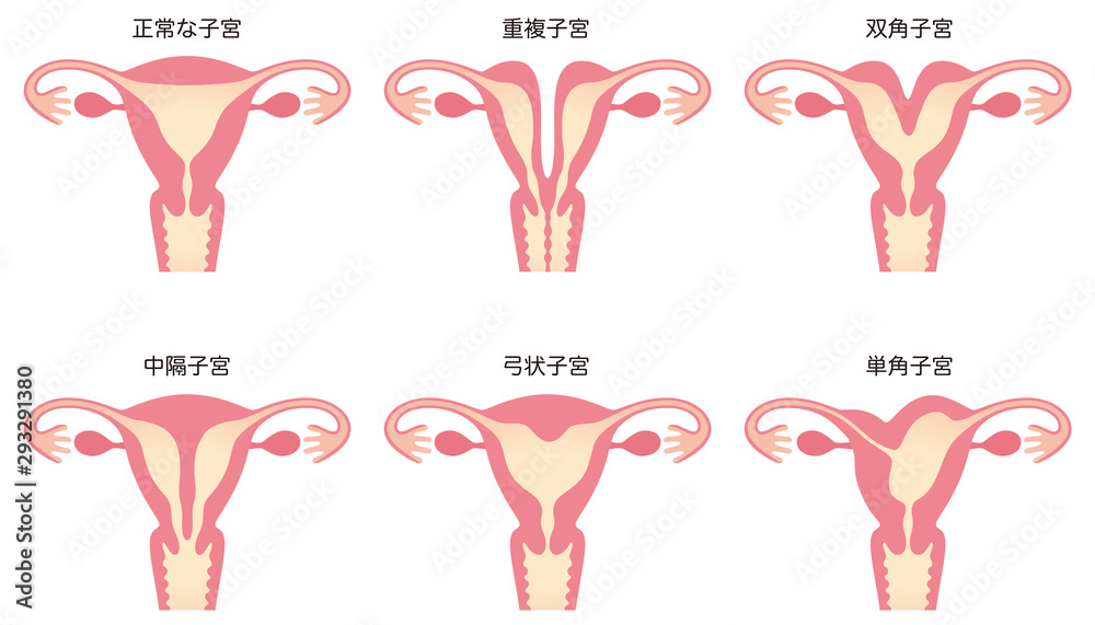 両分子宮と双角子宮の違い – 双角子宮 分類 – YTSB