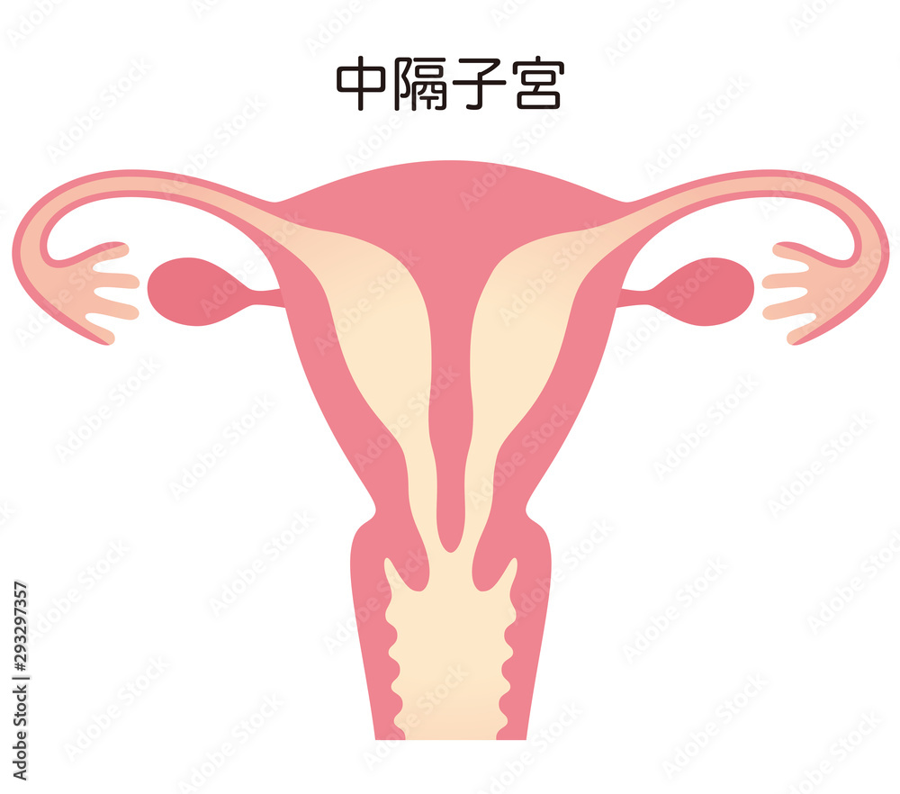 子宮奇形 中隔子宮 Stock Illustration Adobe Stock