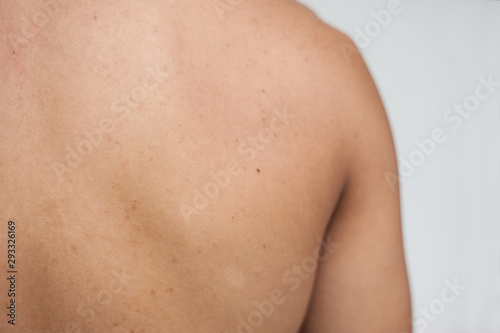 Acne skin. Acne skin on the back. Human skin.