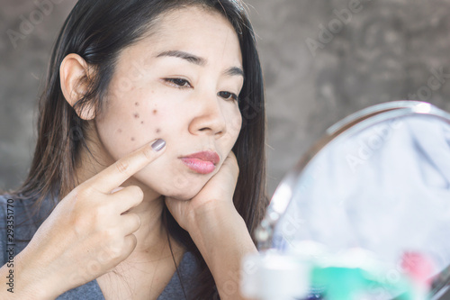 unhappy Asian woman checking her face skin problem with dark spot from scar acne 