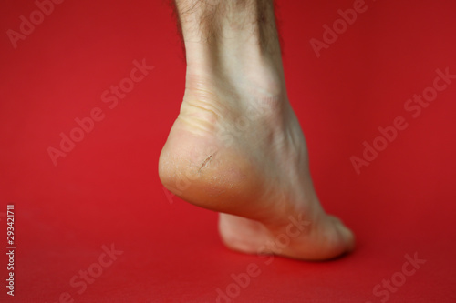 Close-up of heel of foot with bad skin covered with cracks. Female gam exposed to camera on lower view angle. Moisturizing cream advertisement concept. Isolated on red background