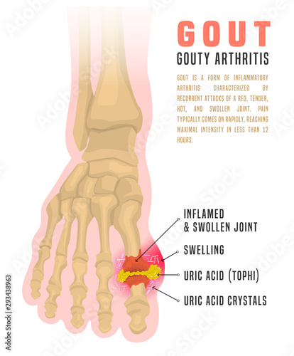 Gout arthritis infographic