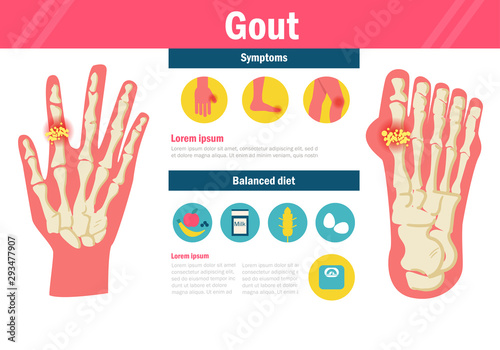 Gout Vector. Cartoon. Isolated art on white background.