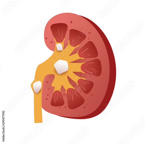 Kidney stone disease Vector. Cartoon. Isolated art on white background. Flat