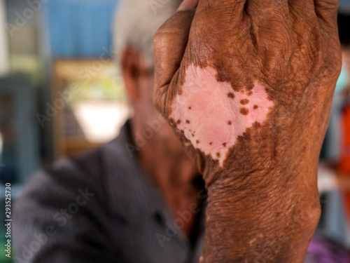 Konstfotografi White spotted skin disease on arms asian man