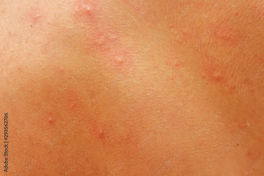 urticaria allergy on skin  back