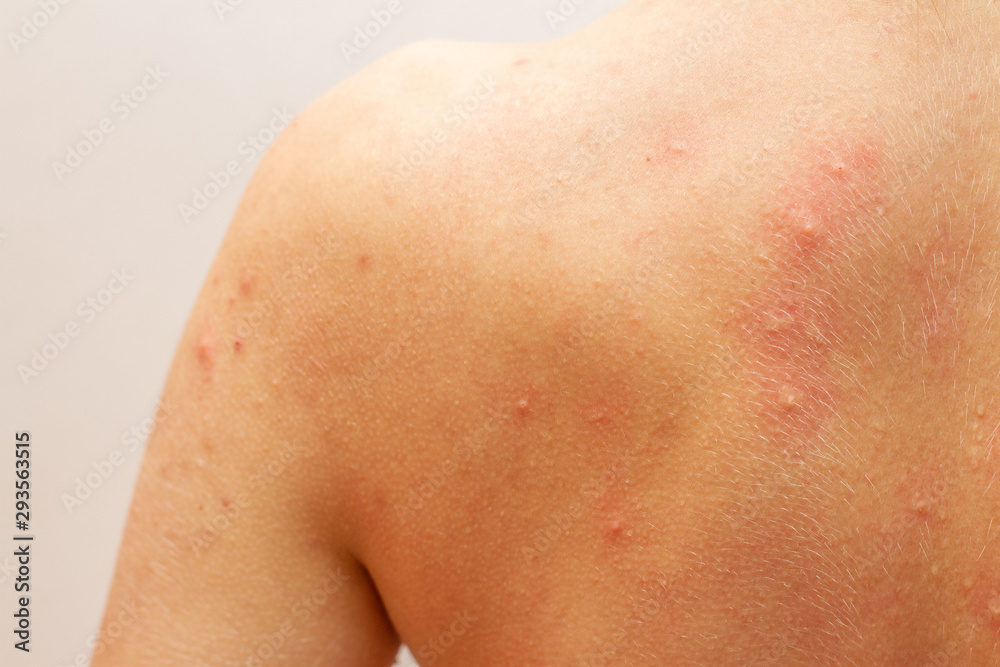 back skin in acne and irritation back skin in acne and irritation