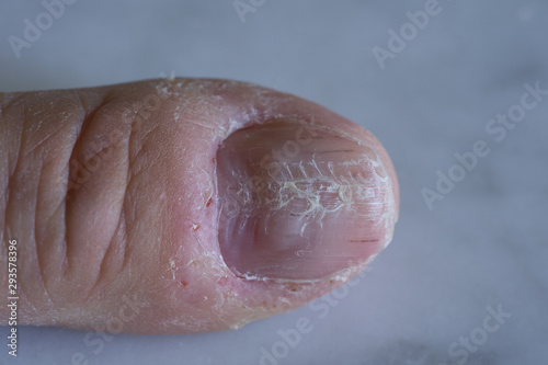 Foto Psoriasi