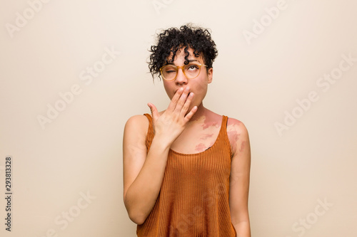 Young african american woman with skin birth mark yawning showing a tired gesture covering mouth with hand.