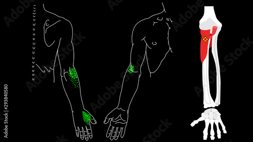 Supinator muscle. Trigger points in the muscles of the hands. photo