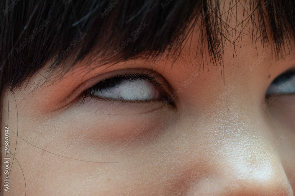 A closeup view on the eyes of a young child during a seizure, child