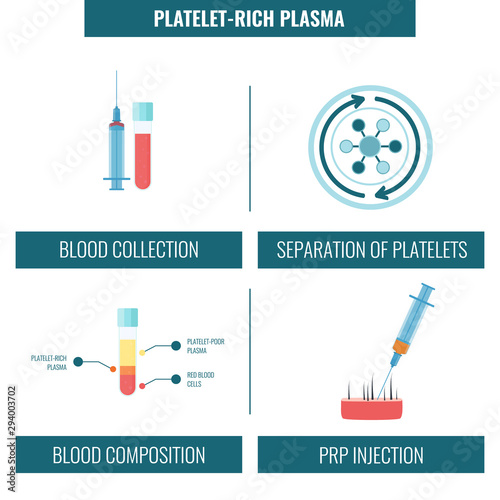 Platelet rich plasma alopecia treatment 4 steps infographics. PRP hair loss treatment steps. Flat vector illustration. Medical design template for transplantation clinics and diagnostic centres.