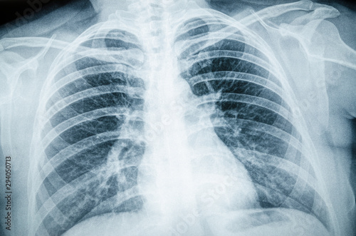 Radiographic image of the respiratory tract, lungs, ribs photo