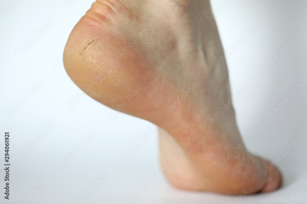 Fototapeta premium Close-up of dry leg covered with painful callous. Female heel shown in modern photography studio to expose illness. Moisturizing cream advertisement concept. Isolated on white background
