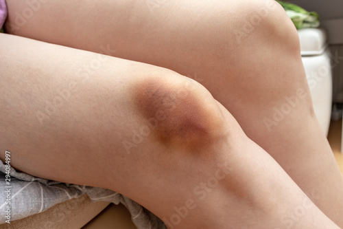 A big bruise  hematoma extravasation on female leg  knee injury