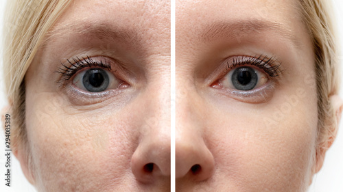 Fotografia Woman face with wrinkles and age change before and after treatment - the result