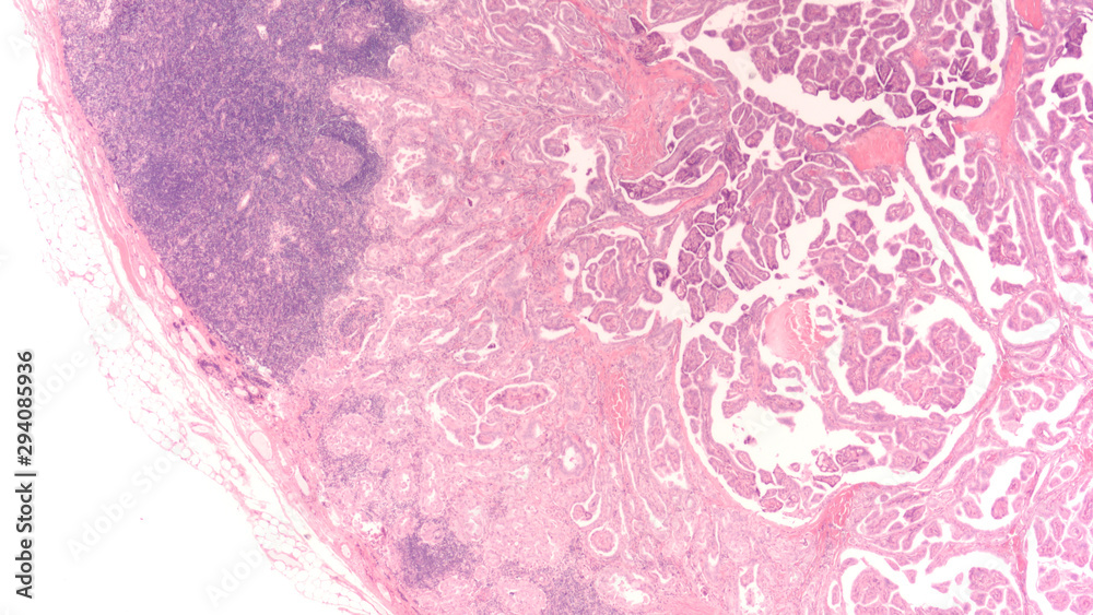 Thyroid Cancer Metastasis Photomicrograph Microscopic Image Of A