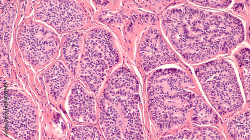 Photomicrograph of a carcinoid tumor, a type of neuroendocrine tumor (NET), which presented as a colon polyp during routine colonoscopy.  Spread to liver can cause symptoms of carcinoid syndrome. photo