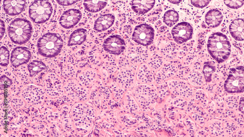 Photomicrograph of a carcinoid tumor, a type of neuroendocrine tumor (NET), which presented as a colon polyp during routine colonoscopy.  Spread to liver can cause symptoms of carcinoid syndrome.