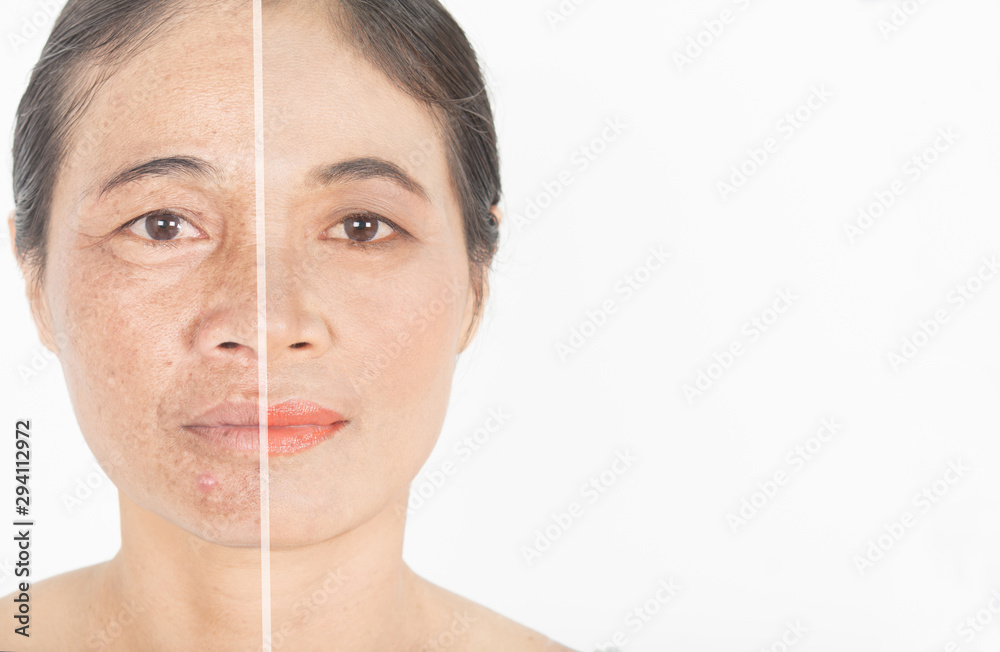 Dark spots on face . and before and after melasma and freckles facial ...
