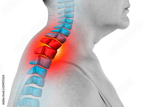 Neck pain, sciatica and scoliosis in the cervical spine isolated on white background, chiropractor treatment concept photo