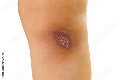 Soft focus lesions with lymph on knee isolate white background.