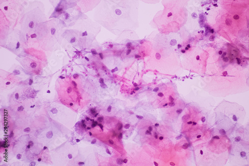 Canvas Print View in microscopic of Candidiasis, fungus infection (Yeast and Pseudohyphae form) in pap smear slide cytology and diagnostic by pathologist