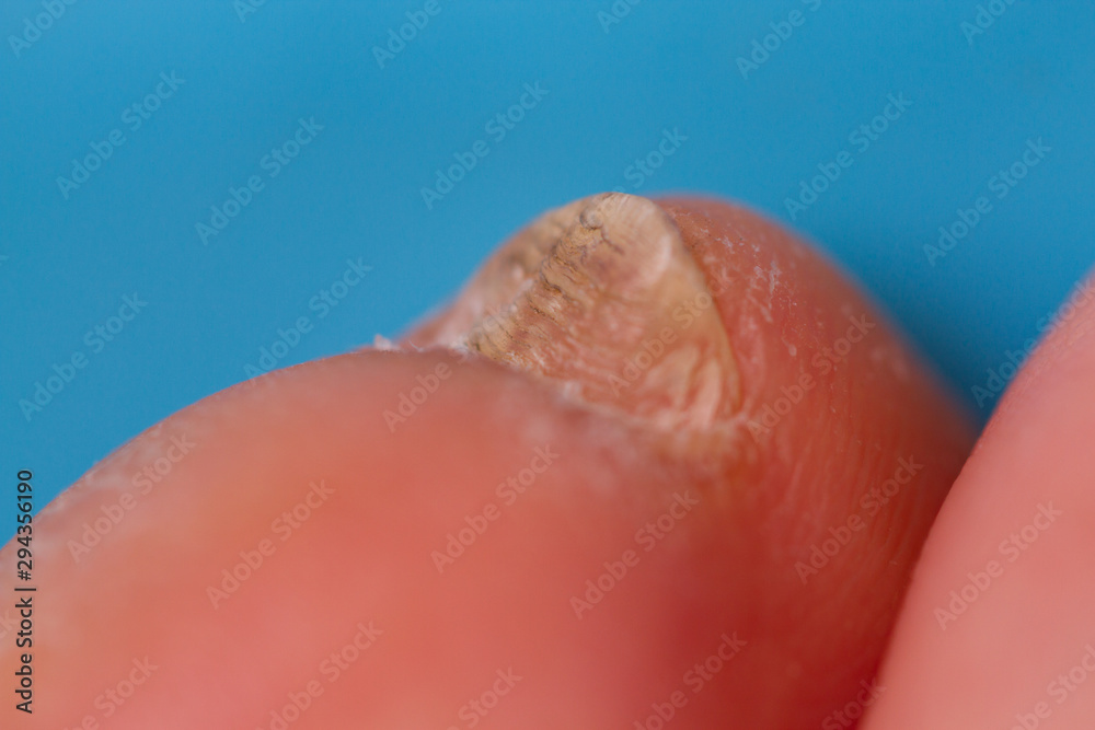 Fototapeta premium Nail infection concept image