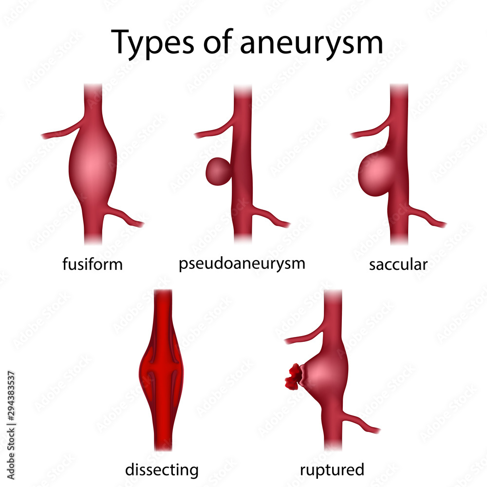 Types Of Aneurysm Fusiform Pseudoaneurysm Saccular Dissecting