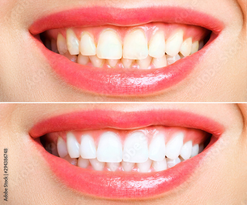 woman teeth before and after whitening. Over white background photo