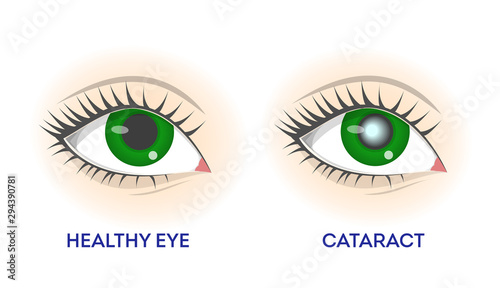 Healthy eye and cataract. Retina disease, problems with vision