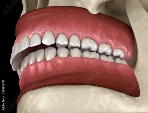 Overbite dental occlusion ( Malocclusion of teeth ). Medically accurate tooth 3D illustration photo