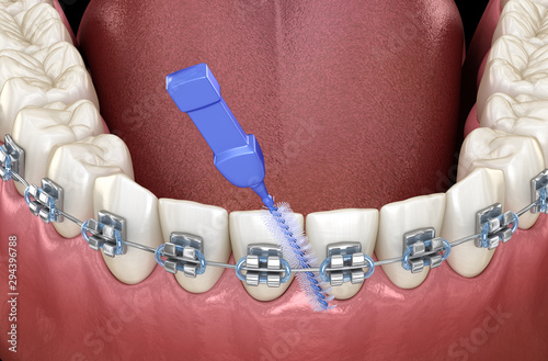 Interdental tooth brush and braces cleaning. Medically accurate 3D illustration of oral hygiene. photo