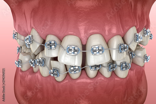 Abnormal teeth position and metal braces tretament. Medically accurate dental 3D illustration photo