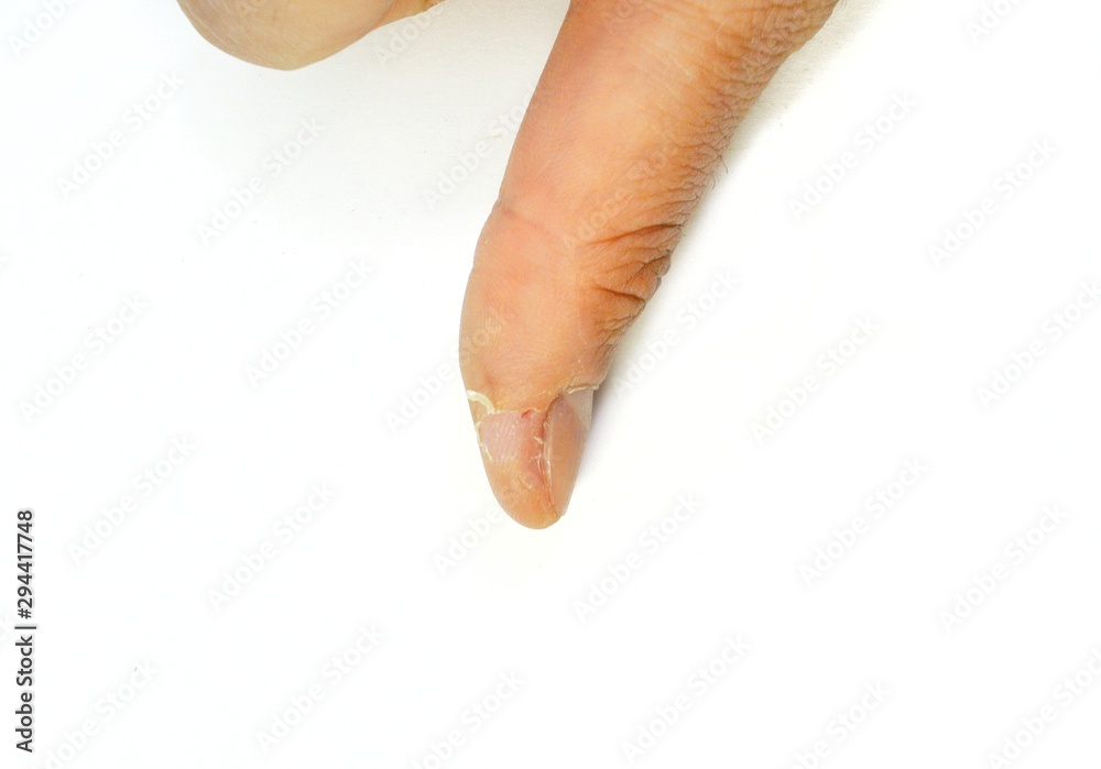 Excoriation (skinpicking) Disorder.Picking The Skin Around Nails and