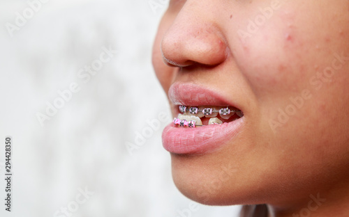 Braces to treat symptoms prognathism