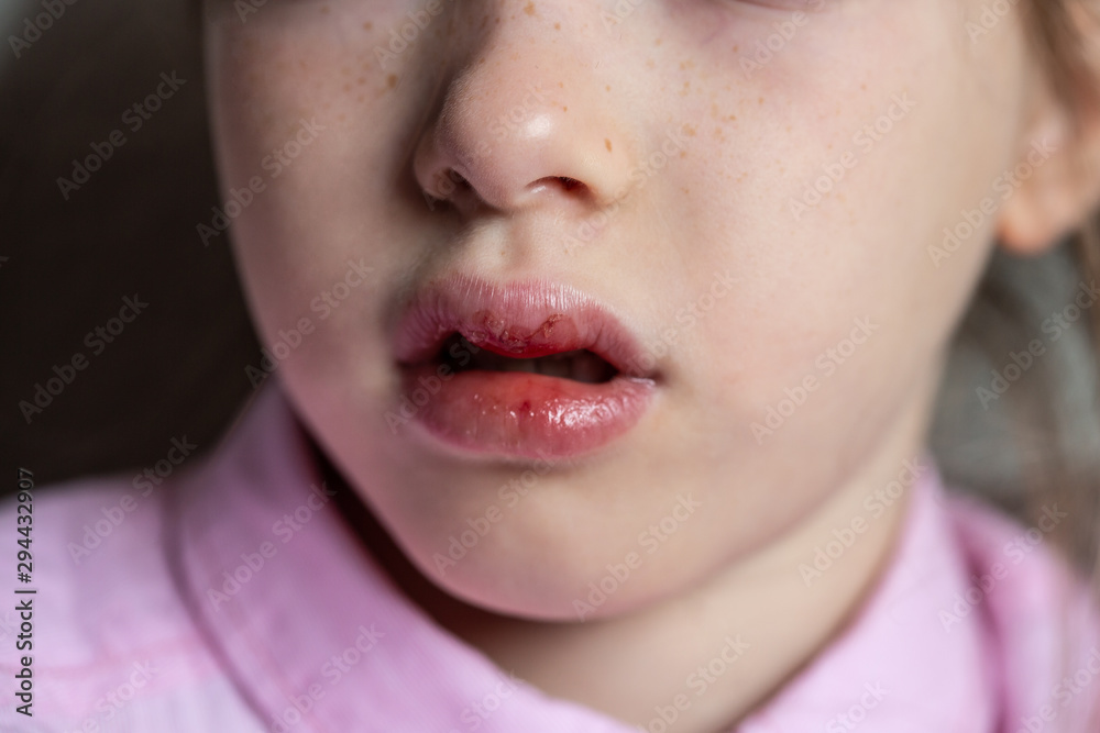 little sad girl with a wounded lip, injury