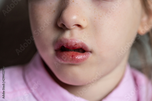 Obraz na płótnie little sad girl with a wounded lip, injury w salonie