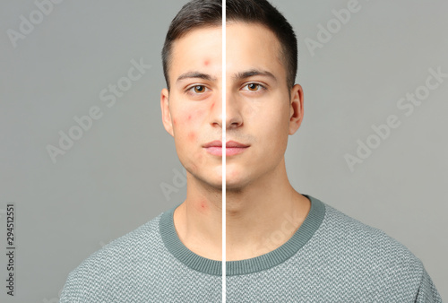 Portrait of young man with acne problem on grey background photo