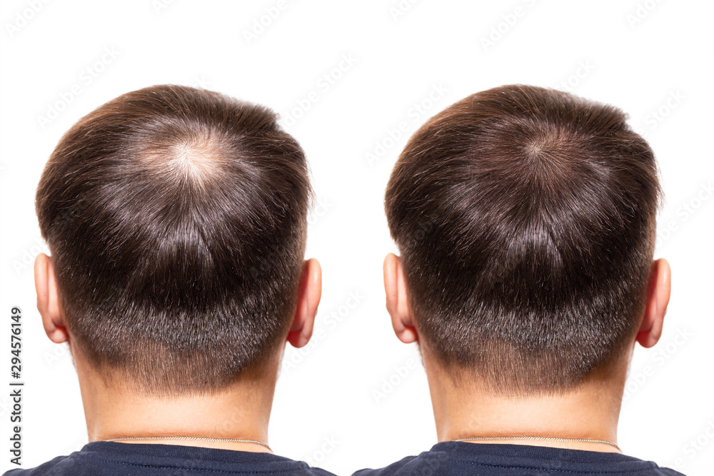 Hair loss. Men view from the back, comparison of hair before and after  transplantation. bald head. baldness treatment. Medicine. thick healthy hair.  head. people - problem hair, white background Stock Photo |