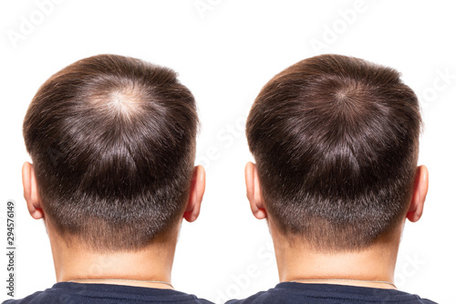 Hair loss. Men view from the back, comparison of hair before and after transplantation. bald head. baldness treatment. Medicine. thick healthy hair. head. people - problem hair, white background 